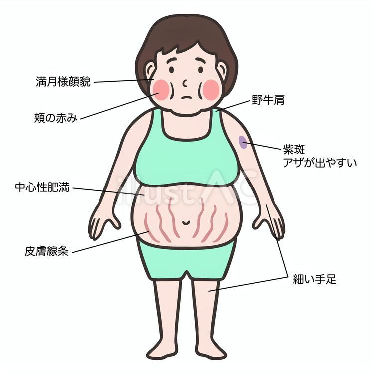 クッシング症候群の女性、症状 クッシング症候群,クッシング,満月様顔貌のイラスト素材