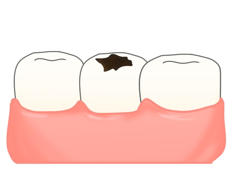 虫歯 虫歯,歯,歯茎,う歯,痛い,歯医者,歯科のイラスト素材