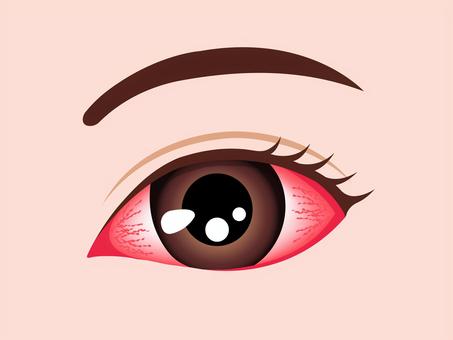 結膜炎の目 イラスト 結膜炎,アレルギー,目,充血,眼,赤い,かゆみ,花粉症,目玉,眼球のイラスト素材