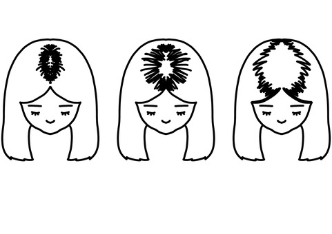 生え際の脱毛症拡大　線画 生え際,脱毛症,病気,頭皮,頭髪,女性,線画のイラスト素材