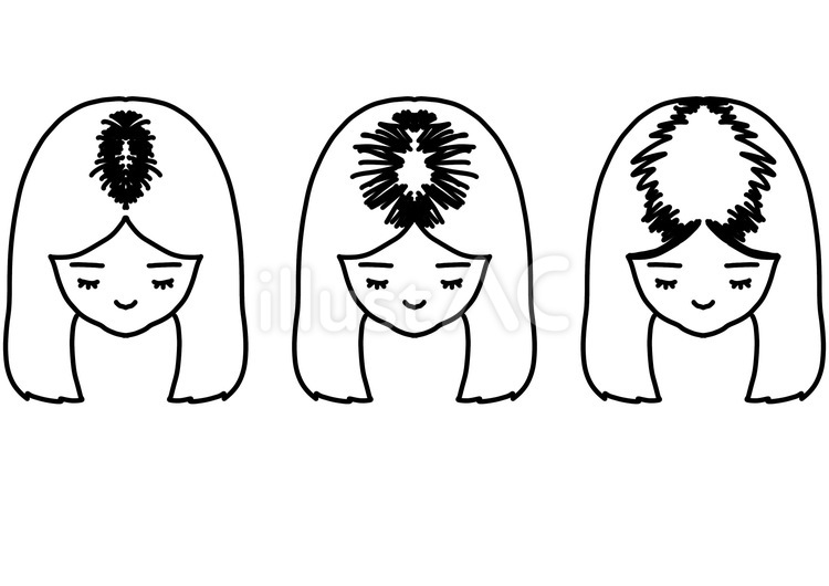 生え際の脱毛症拡大　線画 生え際,脱毛症,病気のイラスト素材