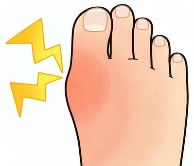 痛風発作 痛風,発作,尿酸,尿酸値,尿酸結晶,生活習慣病,激痛,痛み,炎症,プリン体のイラスト素材