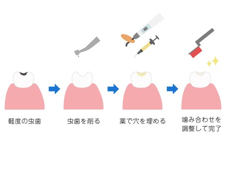 歯科　軽度の虫歯の治療説明２　（改）　 虫歯,歯科,歯,治療,説明,流れ,軽度,cr,ｃ処,充填のイラスト素材