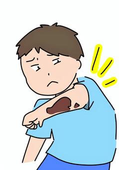 腕に内出血のある男性　カラー 腕,内出血,怪我,男性,カラーのイラスト素材