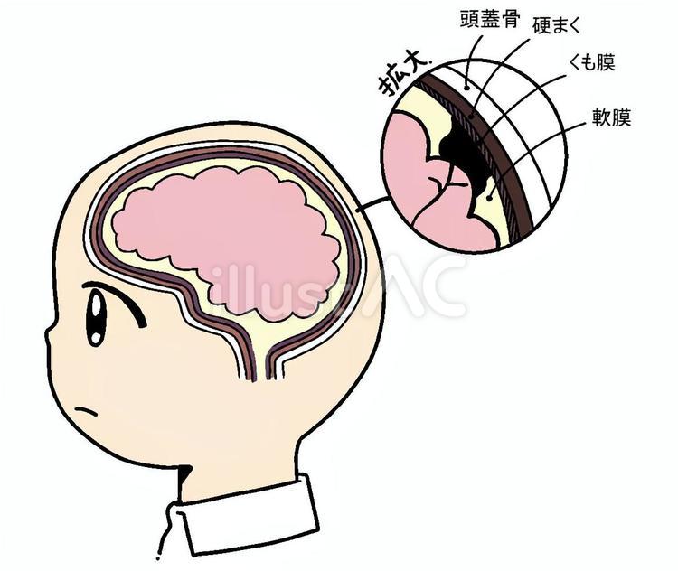 くも膜下出血 くも膜,クモ膜下出血,脳のイラスト素材