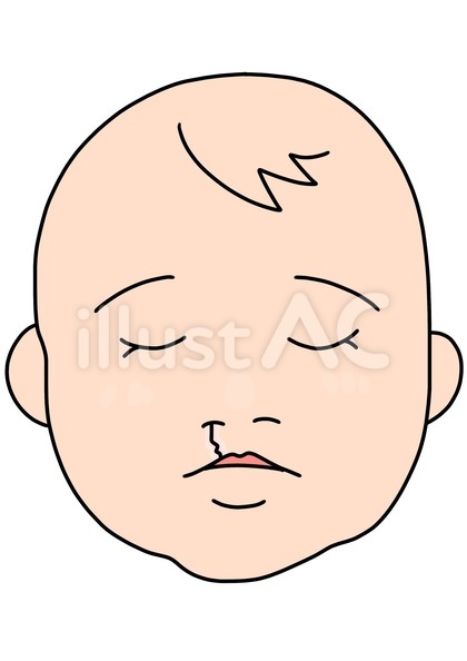 口唇裂を縫った後の子供 カラー