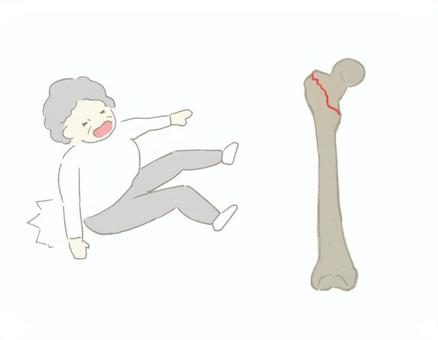 삽화, 골절, 정형 외과, 수상기 회전, 