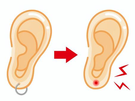 ピアス穴トラブルで痛む耳のイラスト素材2 耳,傷,かぶれ,ピアス穴,症状,痛み,医療,人体,簡単,かわいいのイラスト素材