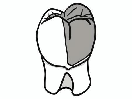 プロキシマルハーフクラウン(シンプル) 歯科,クラウン,補綴,大臼歯,歯科技工,医療,教材用イラスト,vectorのイラスト素材