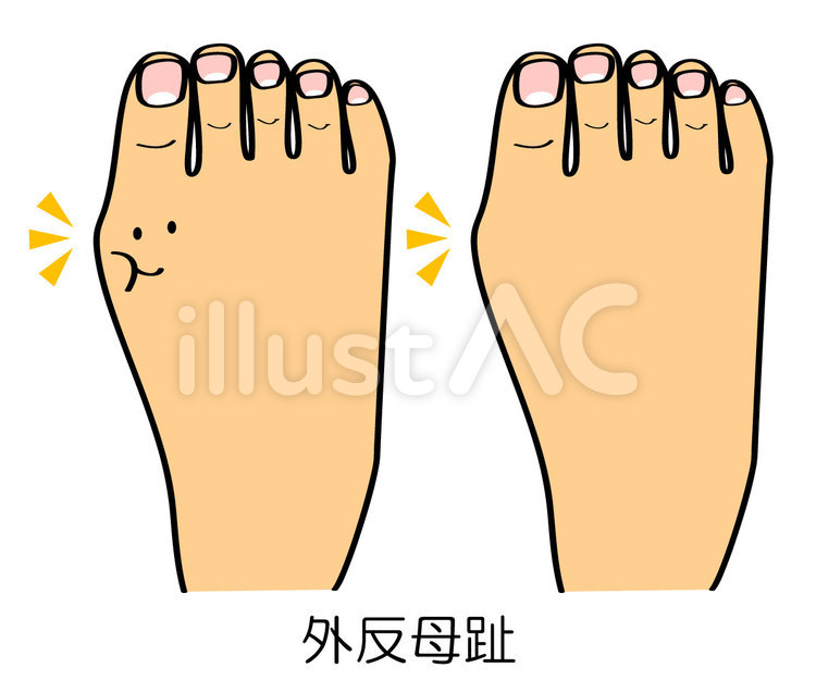 外反母趾 外反母趾,足,指のイラスト素材
