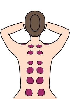 背中にカッピングの痕がある女性　カラー