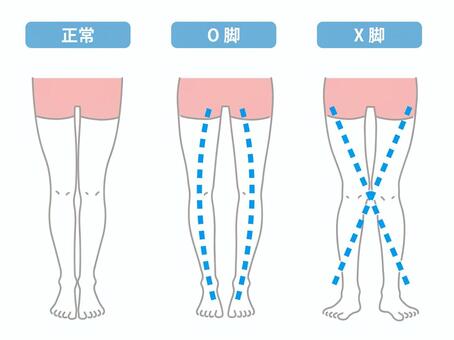 Illustration, o feet, x feet, knee pain, 