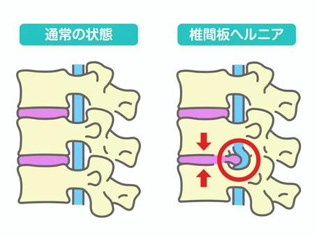 椎間板ヘルニア 腰椎,背骨,神経,図,椎間板,ヘルニア,腰痛,坐骨神経痛,原因,症状のイラスト素材