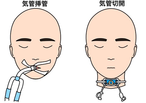 気管挿管と気管切開の比較　カラー 気管挿管,気管切開,比較,患者,治療,カラーのイラスト素材