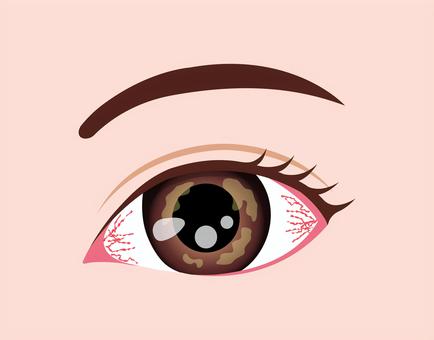 目の病気イラスト / 角膜ヘルペス 角膜ヘルペス,眼,目,病気,角膜,目玉,眼球,ヘルスケア,顔,医療のイラスト素材