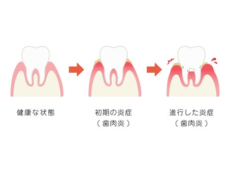 歯科　歯周病の進行の説明　文言付き 歯科,歯周病,説明,歯肉炎,歯周炎,歯槽膿漏,歯ぐき,歯茎,歯肉,炎症のイラスト素材