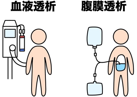 2種透析方法　カラー 腹膜透析,血液透析,比較,ダイアライザー,カラーのイラスト素材
