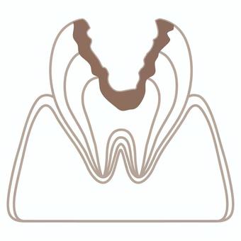충치가 치아의 단면 (C3), JPG, PNG 및 AI 충치가 치아의 단면 (C3), 치아, 단면, 카리에스, JPG, PNG 및 AI