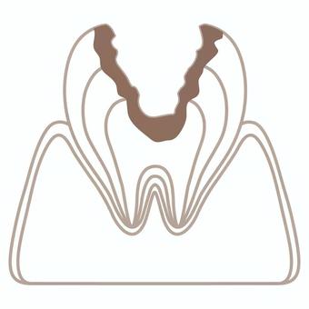 Cross section of cavities (C3), zahn, abschnitt, karies, JPG, PNG and AI