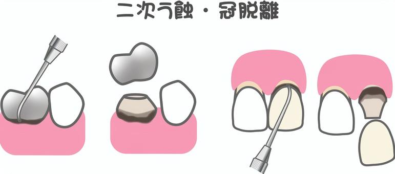 二次う蝕冠脱離 歯科,二次う蝕,冠脱離,むし歯,探針,かぶせもの,前歯,奥歯,歯科治療のイラスト素材