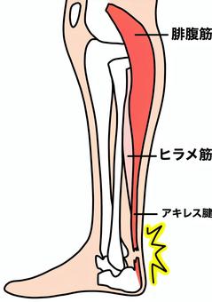 アキレス腱断裂と周辺名称　カラー アキレス腱,足,ヒラメ筋,腓腹筋,断裂,筋肉,カラーのイラスト素材