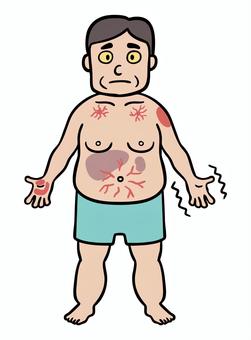 症状が出ている中年男性 肝硬変,肝臓病,症状,腹水,黄疸,浮腫,医療,病気,中年,男性のイラスト素材