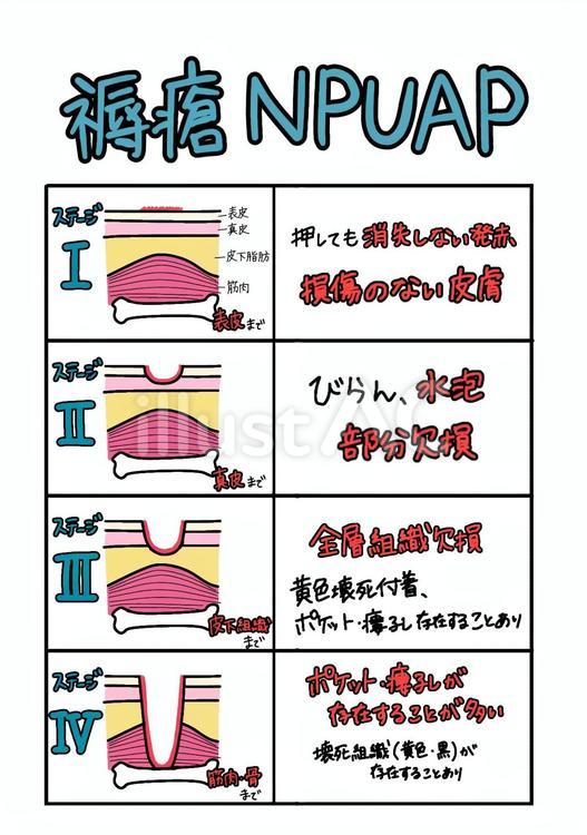 NPUAP分類による褥瘡のステージ分類図 看護,医療,医学教材のイラスト素材