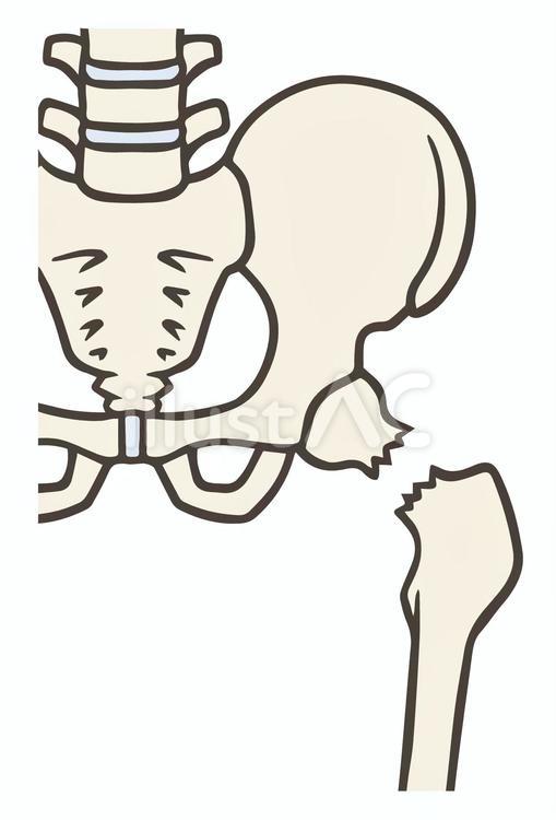 大腿骨頸部骨折 大腿骨頸部骨折,大腿骨,骨折のイラスト素材