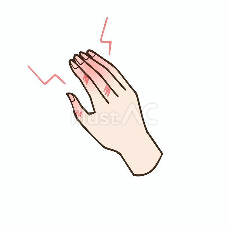 荒れている手 手荒れ,痛い,肌荒れのイラスト素材