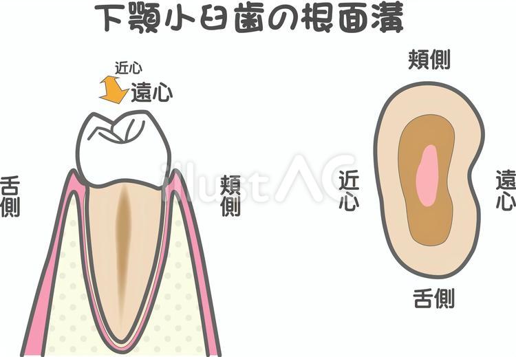 下顎小臼歯の根面溝 根面溝,下顎,小臼歯のイラスト素材