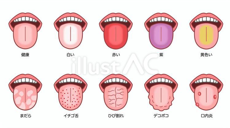 舌診、さまざまな症状の舌セット 舌,舌診,亀裂舌のイラスト素材