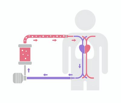 ECMO (エクモ) の構造と仕組み ECMO (エクモ) の構造と仕組み ecmo,エクモ,体外式膜型人工肺,人工肺,治療,救命設備,医療,人工呼吸器,仕組み,構造のイラスト素材