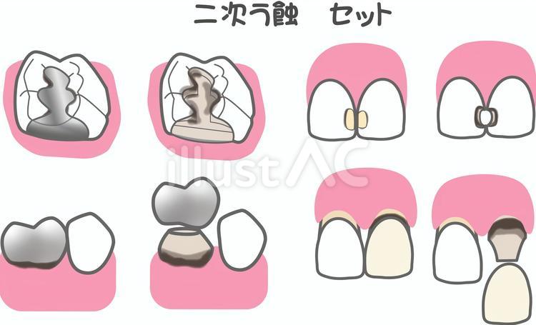 二次う蝕セット 歯科,治療,二次う蝕のイラスト素材