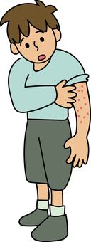 蕁麻疹、皮膚炎の男の子 蕁麻疹,男の子,湿疹,アレルギー,皮膚炎,アトピー,痒い,腕,男性,人物のイラスト素材