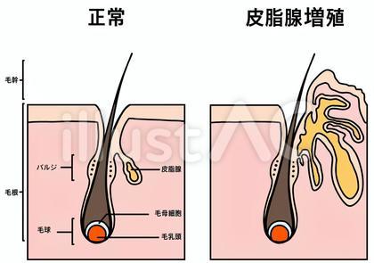 正常と皮脂腺増殖症の断面比較 カラー