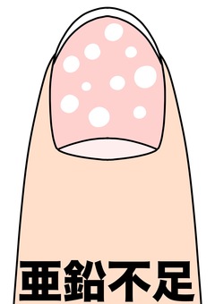 亜鉛不足による爪の斑点　 亜鉛不足,爪,異常,斑点,カラーのイラスト素材