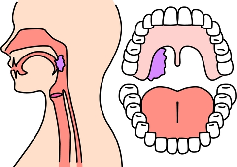 中咽頭癌のある人2つの角度　カラー 中咽頭,癌,腫瘍,病気,耳鼻咽喉科,カラーのイラスト素材