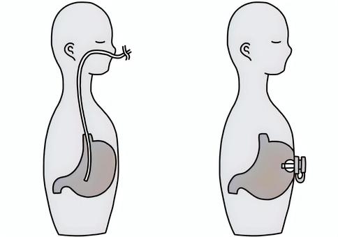 経鼻胃管と胃瘻比較 白黒 経鼻胃管と胃瘻比較 白黒 経鼻,胃管,胃瘻,チューブ,比較,白黒のイラスト素材