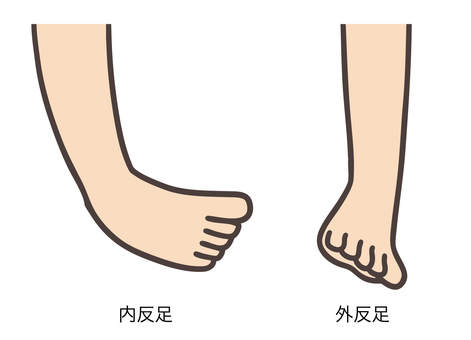 足の変形04 内反足,外反足,足,変形,足関節,足底,後天性,先天性,医学,医療のイラスト素材
