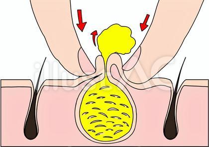 指で圧迫して粉瘤の中身を出す カラー