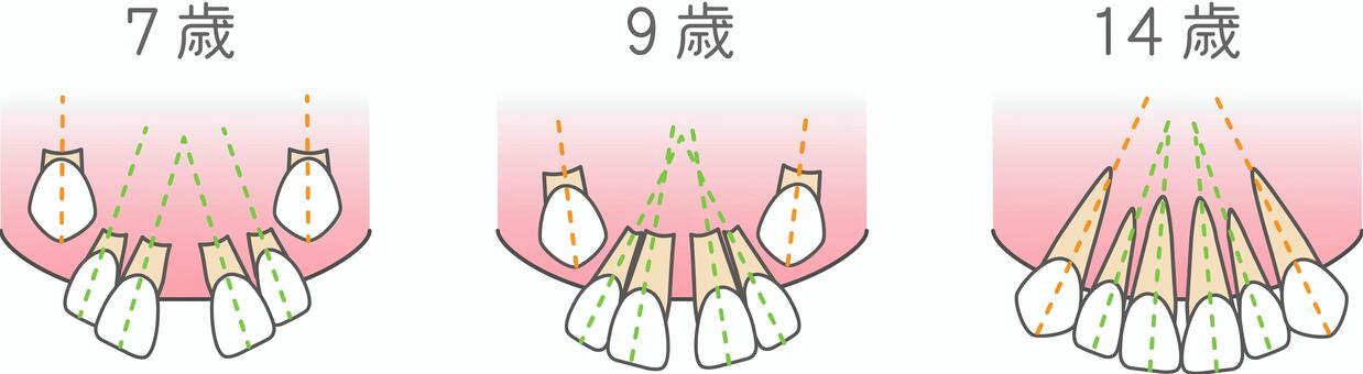 みにくいアヒルの子時代 歯科,矯正,乳歯,永久歯,生え変わり,離開,すきっ歯,前歯,犬歯,萌出のイラスト素材