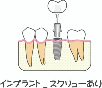 Hình minh họa, nha khoa, implant, đinh ốc, 