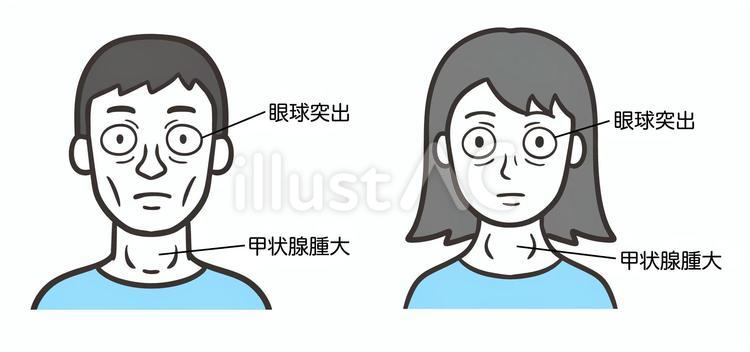 眼球突出と首の腫れがある男と女の顔 眼球突出,バセドウ病,甲状腺機能亢進症のイラスト素材