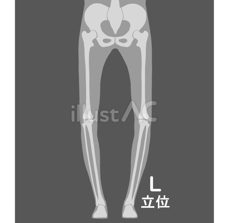 全下肢立位O脚 医療,レントゲン,撮影のイラスト素材