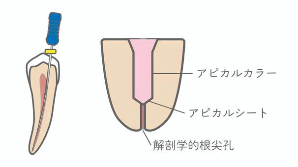 アピカルシート 歯科,歯根,根尖,根尖孔,根管治療,リーマー,ファイル,アピカルシート,アピカルカラー,根管充填のイラスト素材