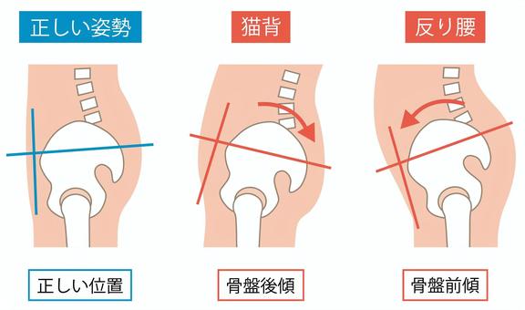 猫背と反り腰と正しい姿勢 背骨と骨盤 猫背と反り腰と正しい姿勢 背骨と骨盤 骨盤,猫背,反り腰,骨格,背骨,後傾,前傾,姿勢,歪み,人体のイラスト素材
