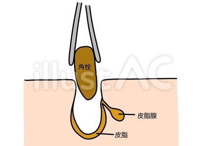 角栓を引き抜く様子 文字ありカラー
