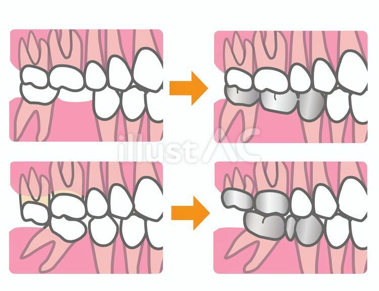 Free Vectors | Prosthetic replacement of erupted teeth