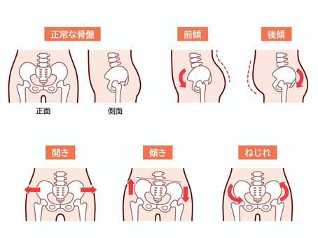 骨盤のゆがみのイラスト 骨盤,腰,股関節,歪み,偏位,坐骨神経痛,姿勢,傾斜,臀部,傾きのイラスト素材