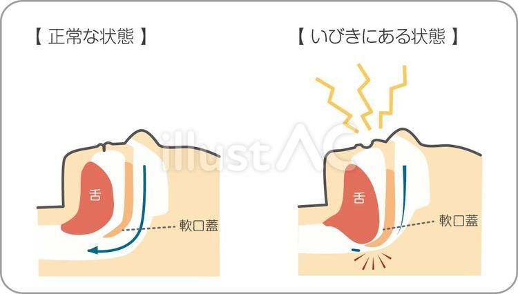 いびきの仕組み いびき,図解,睡眠時無呼吸症候群のイラスト素材